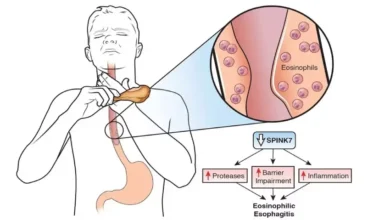 eosinophilic esophagitis nhs
