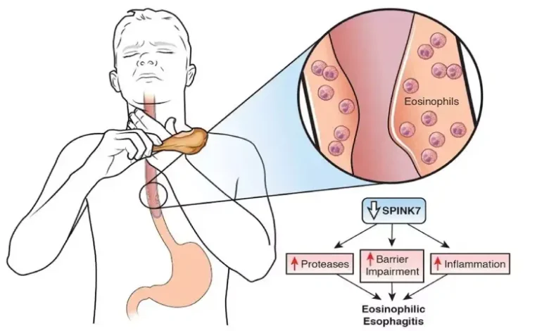 eosinophilic esophagitis nhs